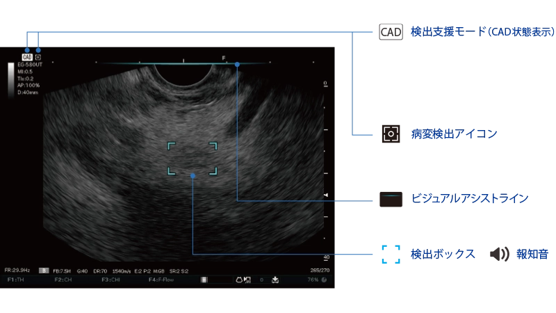 膵充実性病変が疑われる領域を検出した超音波内視鏡画像​​
