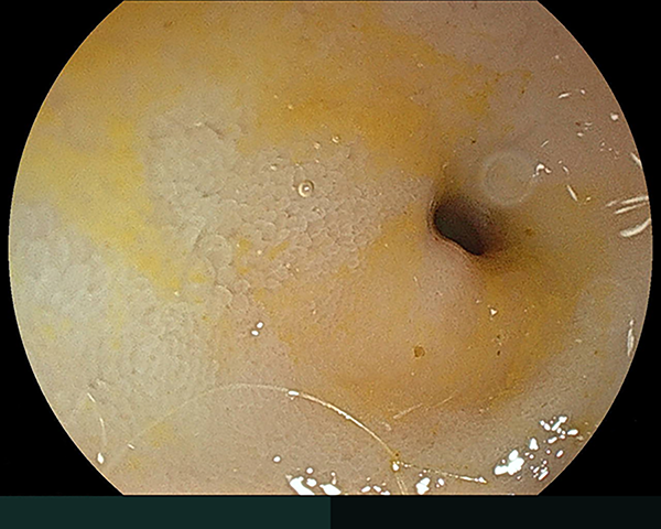 内視鏡症例画像