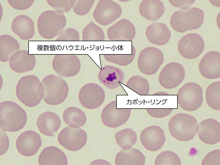 複数個のハウエル・ジョリー小体／カボット・リング