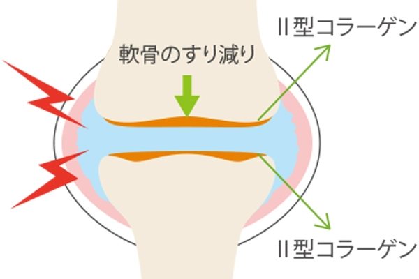関節の炎症により軟骨がすり減り、軟骨成分が漏出する様子