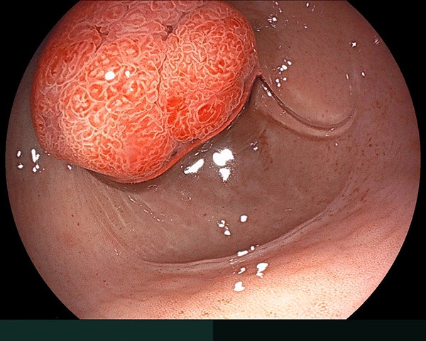 内視鏡症例画像