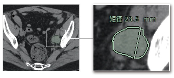 腹部リンパ節抽出のイメージ図