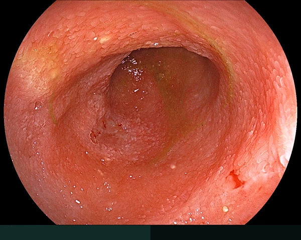 内視鏡症例画像