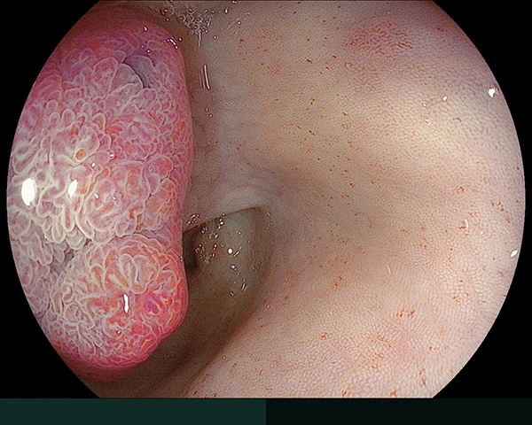 内視鏡症例画像