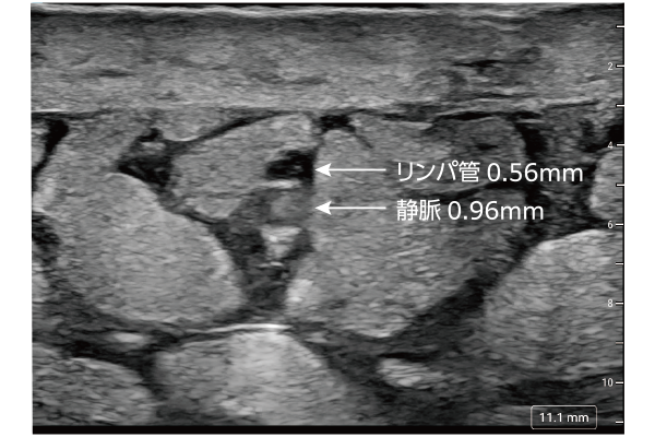 リンパ浮腫画像右