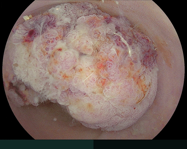 内視鏡症例画像