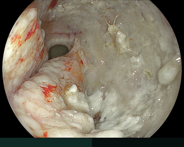 内視鏡症例画像