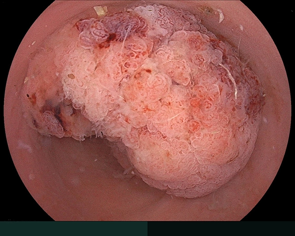 内視鏡症例画像