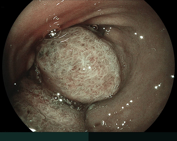 内視鏡症例画像