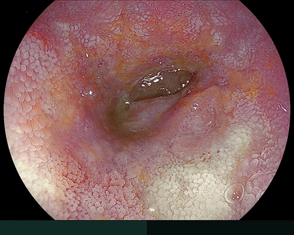 内視鏡症例画像
