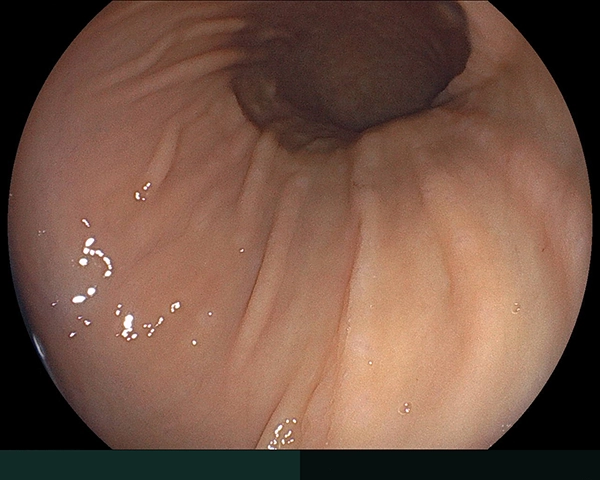 内視鏡症例画像