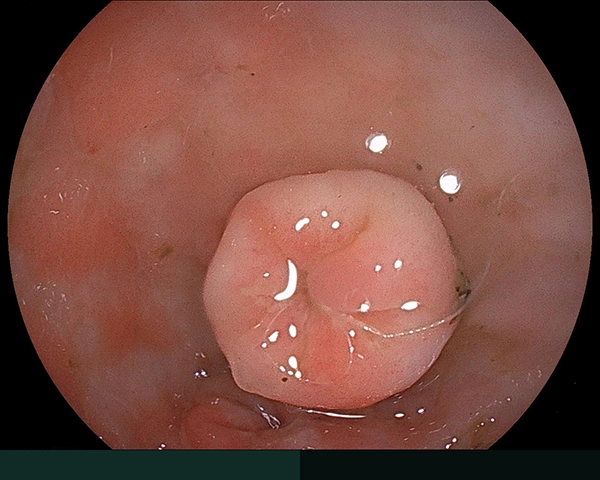 内視鏡症例画像