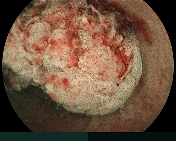 内視鏡症例画像