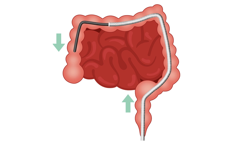 ShapeShieldを使用した大腸内視鏡挿入のイメージ