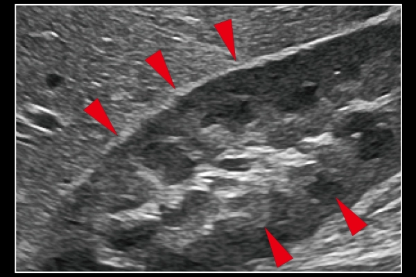 Carving Imaging ONの画像です。組織構造の視認性を追及した「見やすい」画像を実現。被検者依存の少ない安定した描出を実現します