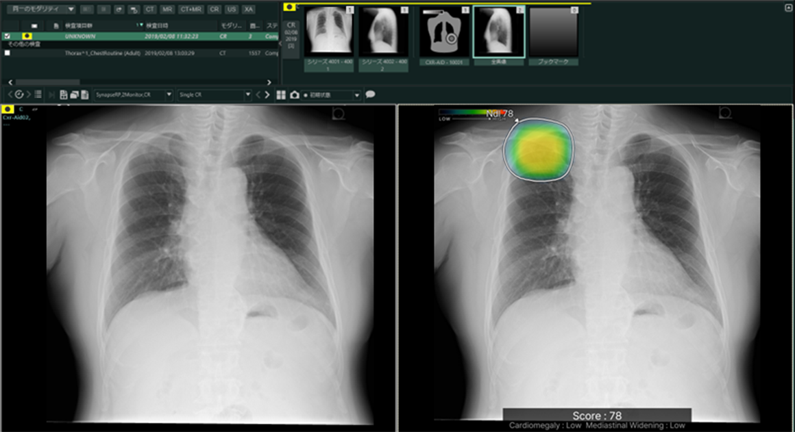 CXR-AIDの処理結果表示イメージ図