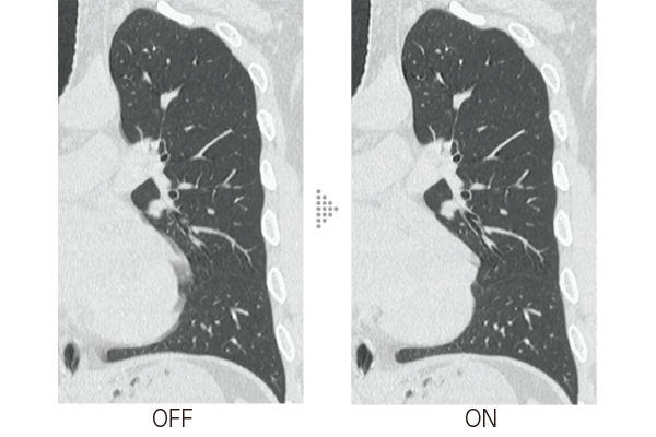 Example of applying Body StillShot to axial images of the chest. The left image shows Body StillShot OFF, while the right image shows Body StillShot ON. Body StillShot improves pulsation artifacts.