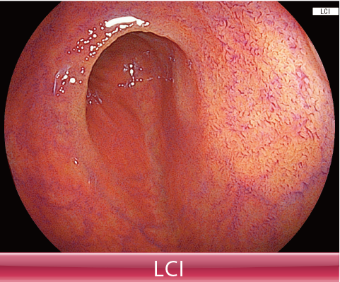Clinical image：LCI