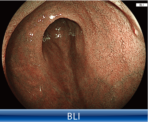 Clinical image：BLI