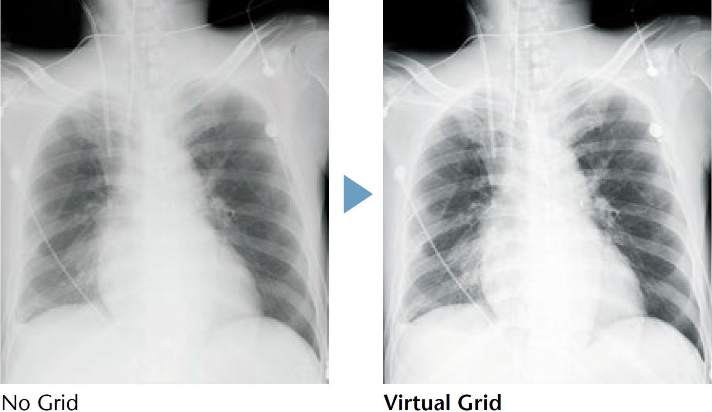 [photo] X-ray images of chest comparison of no grid versus virtual grid