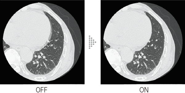 Example of applying Body StillShot to axial images of the chest. The left image shows Body StillShot OFF, while the right image shows Body StillShot ON. Body StillShot improves pulsation artifacts.