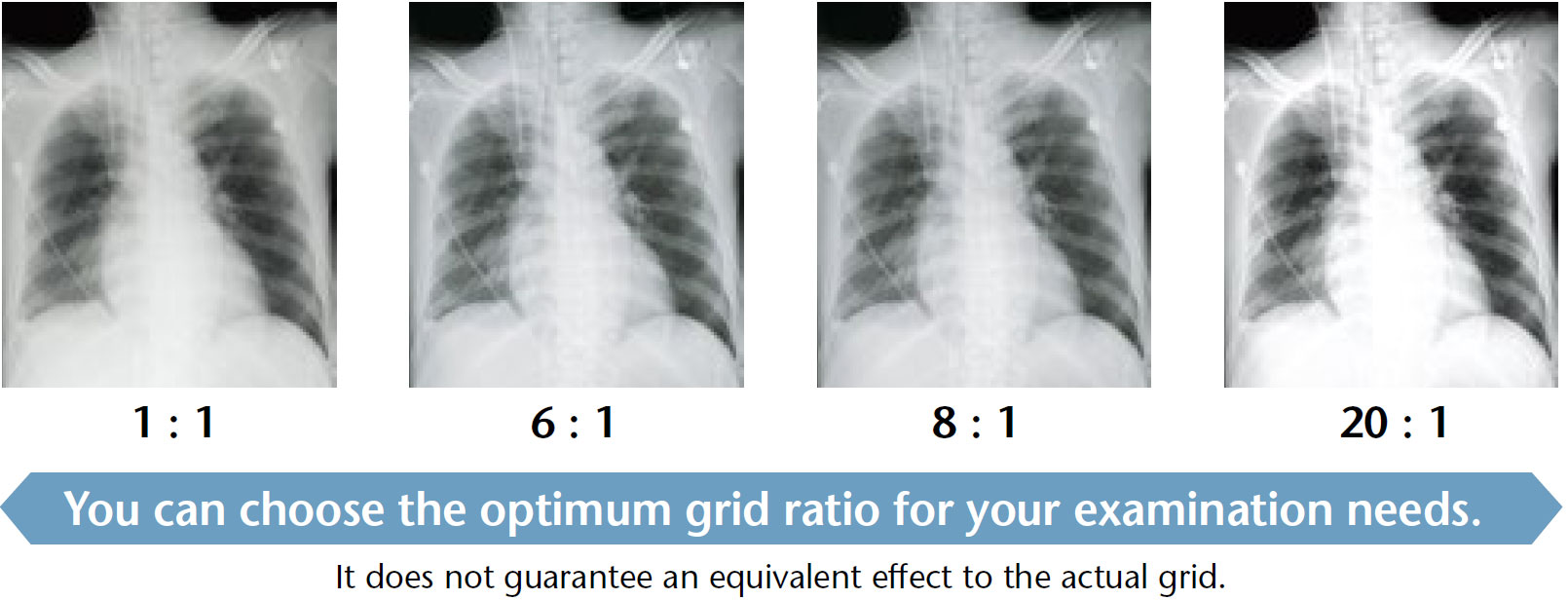 [photo] 4 X-ray images of chest and lungs with 1:1, 6:1, 8:1, and 20:1 grid ratios