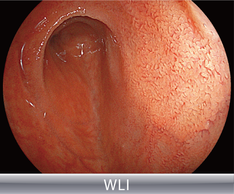 Clinical image：White Light Imaging