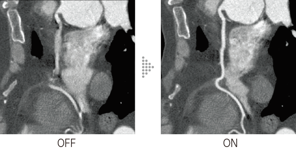 Example of applying Cardio StillShot to MPR images of the heart. The left image shows Cardio StillShot OFF, while the right image shows Cardio StillShot ON. This function Cardio StillShot contributes to reducing artifacts caused by heart motion in coronary arteries.