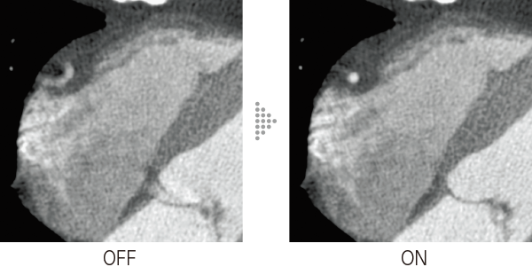 Example of applying Cardio StillShot to axial images of the heart. The left image shows Cardio StillShot OFF, while the right image shows Cardio StillShot ON. Cardio StillShot contributes to reducing artifacts caused by heart motion in coronary arteries.