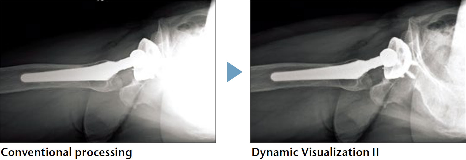 [photo] 2 X-ray images of joint replacement - one with conventional processing and the other with Dynamic Visualization II