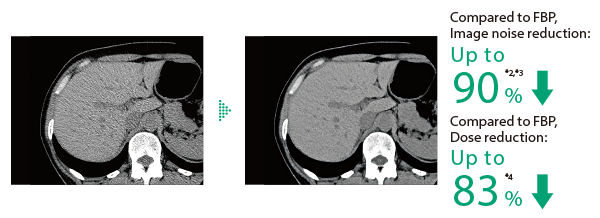 Here are images of the abdominal region. One is the filtered back-projection (FBP) image, and the other is an Intelli IPV image. Intelli IPV reduces noise by up to 90% and radiation dose by up to 83% compared to FBP. Noise reduction was measured at the Intelli IPV intensity level Strong5 on a water phantom. Dose reduction was measured at 0.625 mm slice thickness on the MITA CT IQ phantom by Phantom Laboratory, also using Strong5.Effects may vary based on clinical task and other factors.