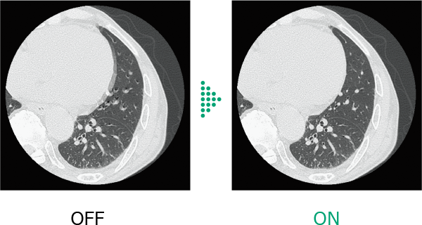 Here are comparative images of axial cross sections in the chest region, showing differences without and with Body StillShot, which suppresses motion blur. Body StillShot can be combined with Intelli IPV, and it is a dedicated option for the Operator Console CT-OC-23D. Intelli IPV was developed using AI-based machine learning, but its performance does not automatically improve after implementation. IPV stands for Iterative Progressive reconstruction with Visual modeling.