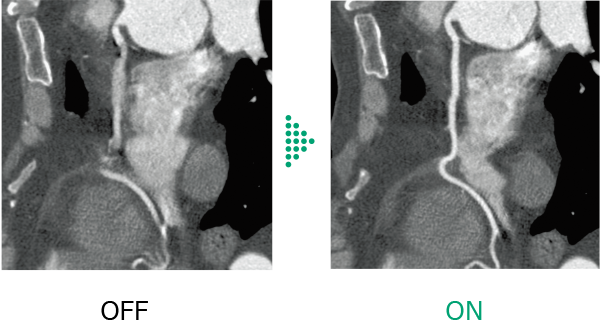 Here are comparative CPR images in the cardiac region, showing differences between cases without and with Cardio StillShot, which suppresses motion blur. By applying corrections during image reconstruction, Cardio StillShot achieves an effective temporal resolution of up to 28 milliseconds in cases with 0.5 seconds per rotation and heart rates of 80 bpm or less. It is a dedicated option for the Operator Console CT-OC-23D and cannot be installed in CT-OC-23C.