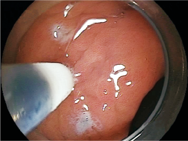 Clinical Image :Marking