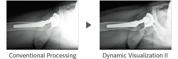Comparison of Dynamic Visualization II vs. conventional processing images (Hip Joint)