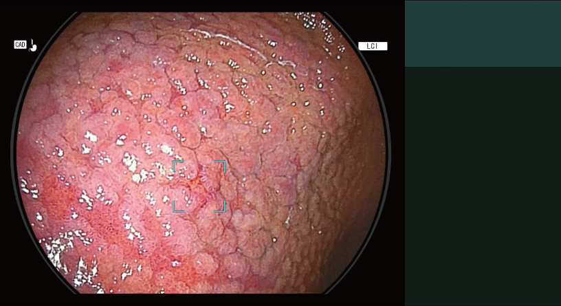 CAD EYE detection working with LCI mode in the stomach.