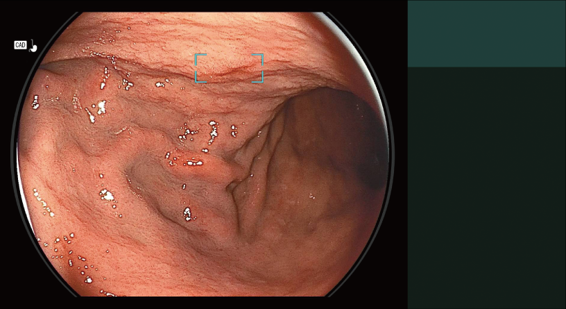 CAD EYE detection working with White Light mode in the stomach.