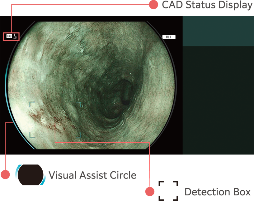 CAD EYE detection working with BLI mode in the esophagus. Displayed icons explained.
