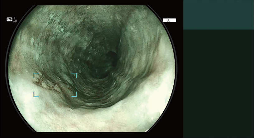 CAD EYE detection working with BLI mode in the esophagus.