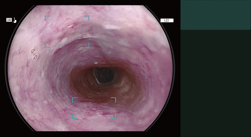 CAD EYE detection working with LCI mode in the esophagus.