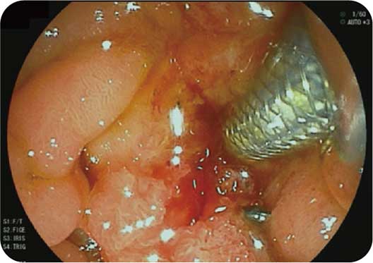 [photo] Forceps on duodenoscope device interacting with soft tissue inside body