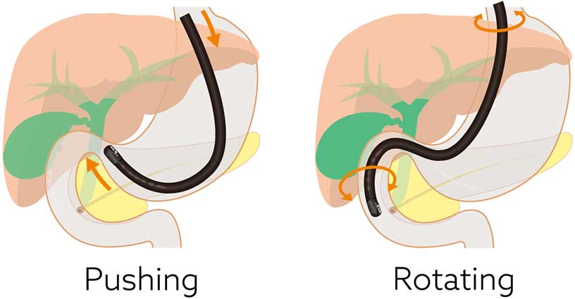 [image] Insertion tube of duodenoscope pushing through stomach and rotating