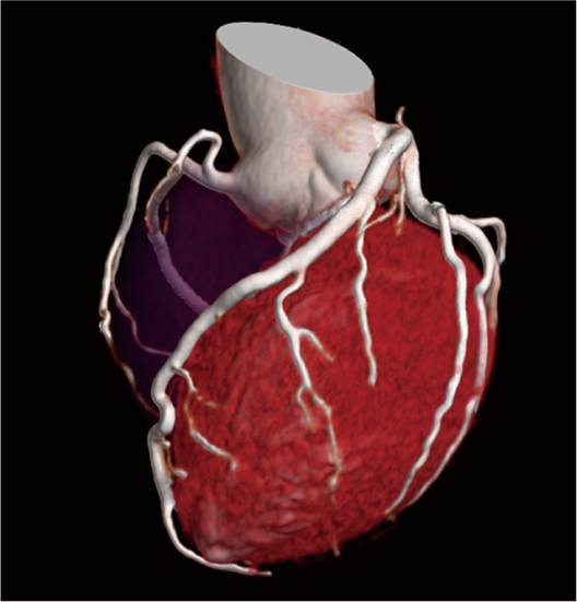 The 3D cardiac image is here which was reconstructed from 2D using CardioHarmony. 