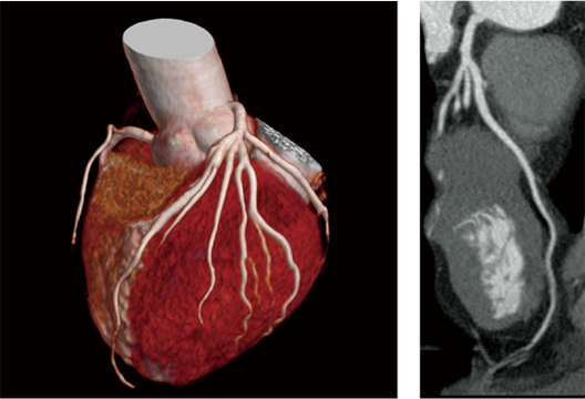 The 3D image of reconstructed cardiac image and 2D image taken using IntelliEC that is the source of the 3D image are shown here.