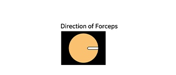Image area and dirrection of forceps