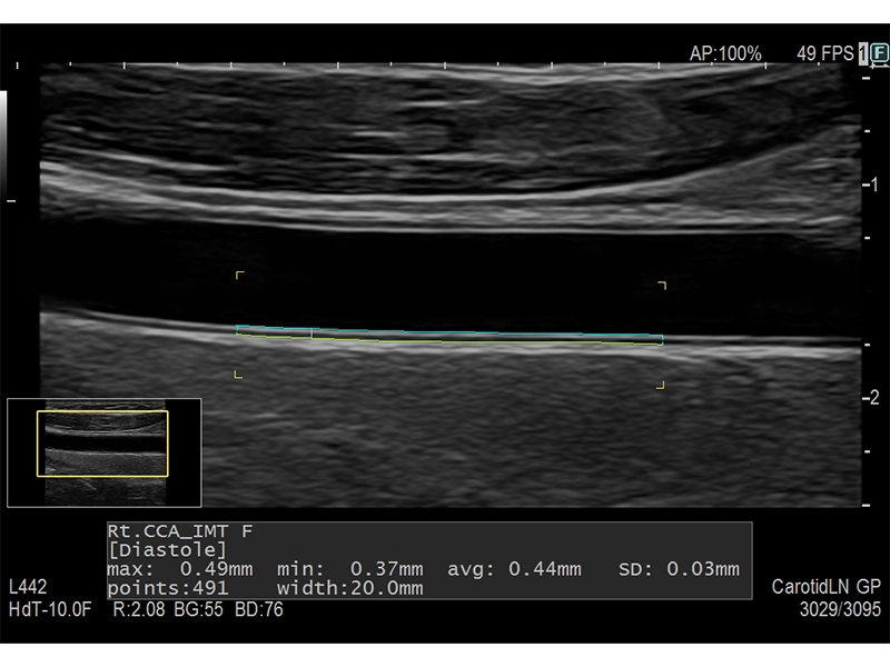 Auto IMT