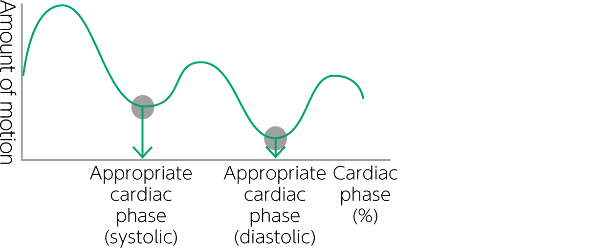 There is a graph showing the amount of cardiac movement in each diastolic cycle here.
