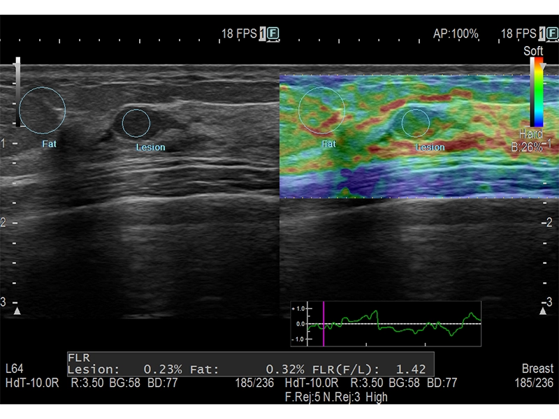 Real-time Tissue Elastography (RTE)​