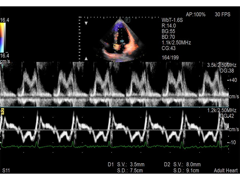 Dual Gate Doppler (DGD)​