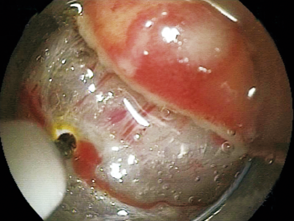Clinical Image ：Coagulation